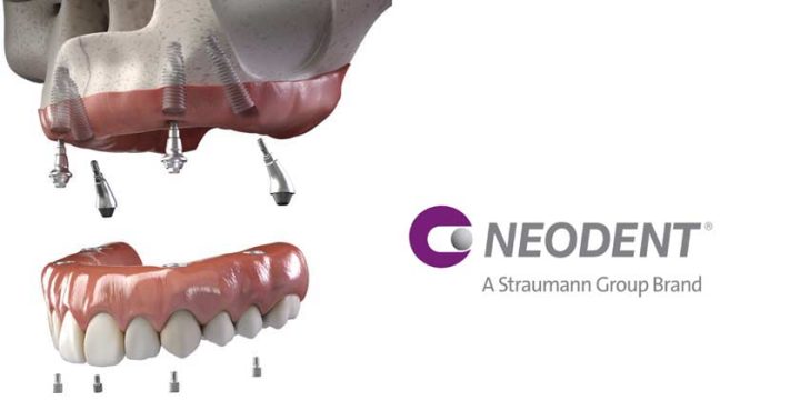 Neodent Implants